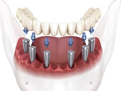 임플란트 보험 임플란트 가격 임플란트 비용 치아 보험 추천 치과 보험 추천 임플란트 치아 보험 치아 보험 적용 기과 보험 적용 치과 보험 임플란트 임플란트 치아