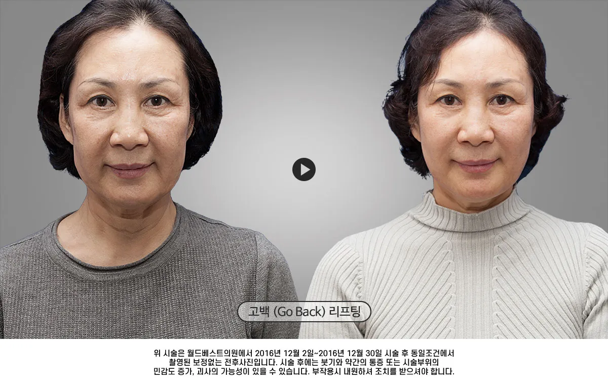 덴서티 리프팅 댄서티 가격 효과 유지기간에 관한 정보_6