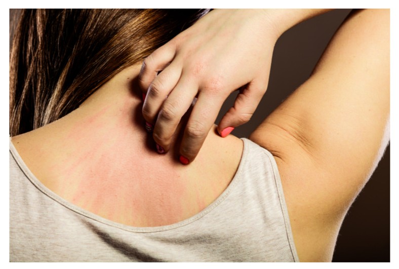 가려움증 이미지