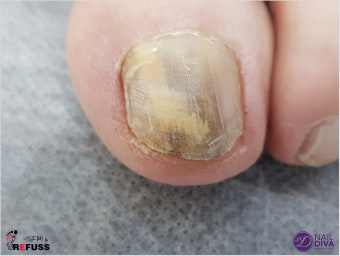 각화비대증과 발톱무좀: 원인&amp;#44; 증상&amp;#44; 예방법 한방에 