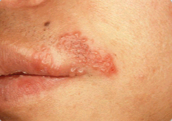 구순포진 입술물집 헤르페스 전염성, 증상, 치료