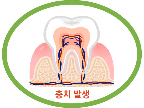충치-발생-그림-설명