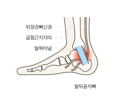 발목저림 발목터널증후군 증상, 원인, 치료, 수술, 예방