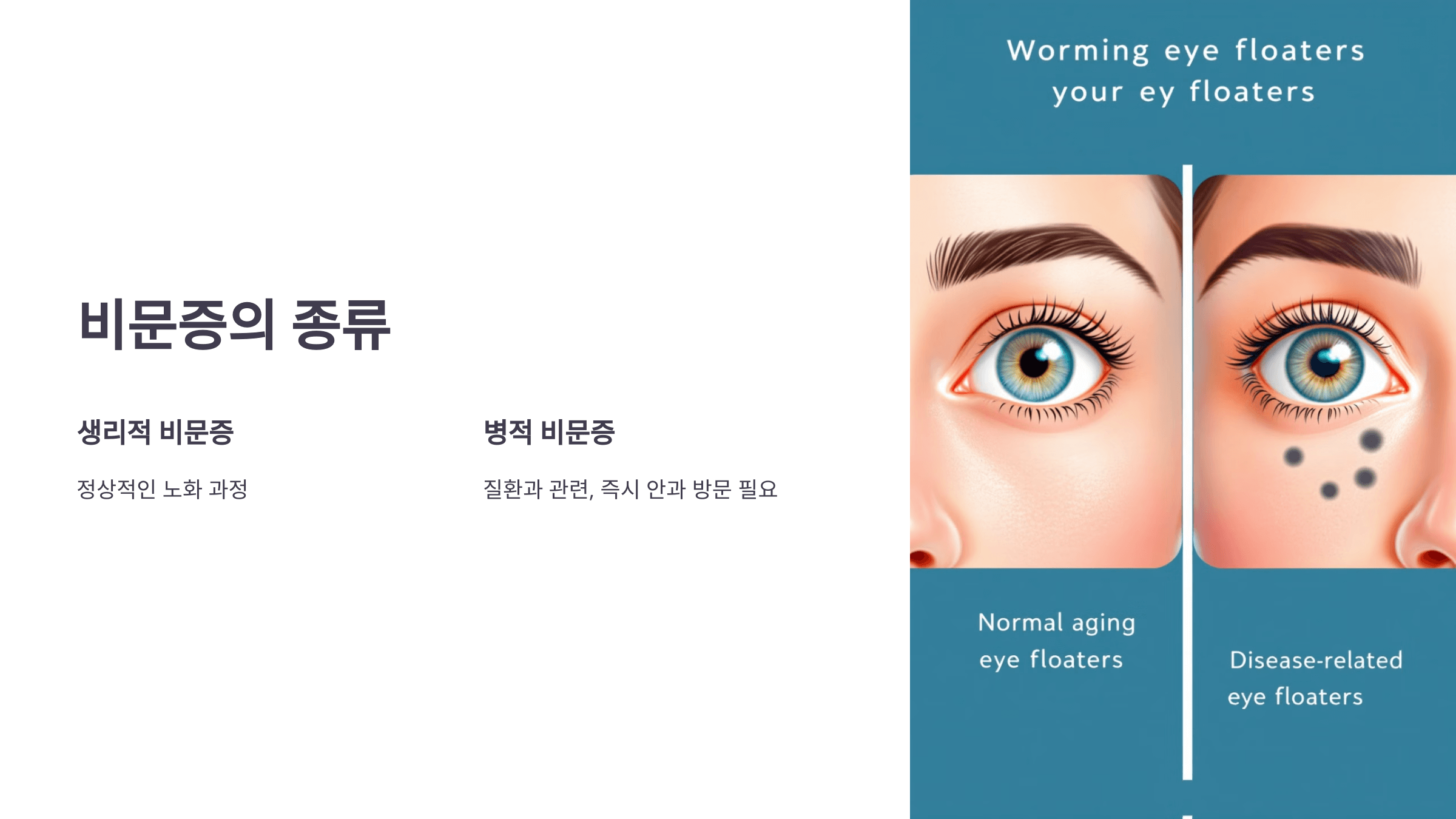 비문증과 관련된 사진입니다.