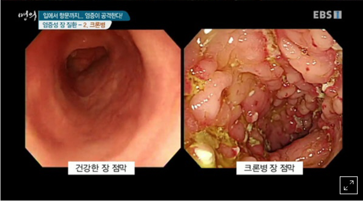 크론병-배탈-차이점-발병-원인-증상-진단-치료-명의-리스트