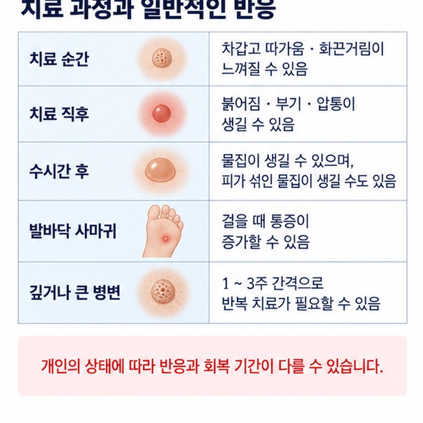 액화질소 치료 중 따가움 화끈거림과 치료 후 붓기 물집 통증 반복 치료 가능성을 보여주는 이미지