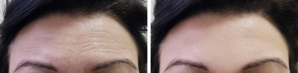 이마 보톡스 효과는 시술 후 7일 전후에 가장 뚜렷하게 나타납니다