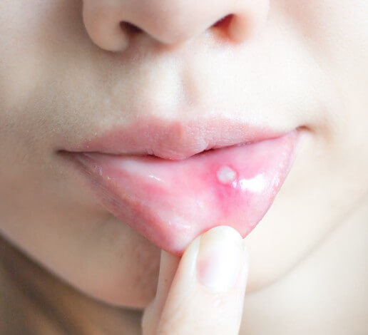 입안에 구내염이 생긴 모습