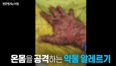 약물알레르기