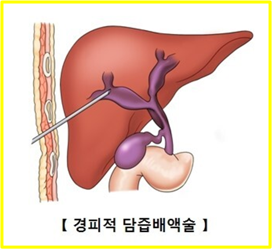 경피적 담즙배액술