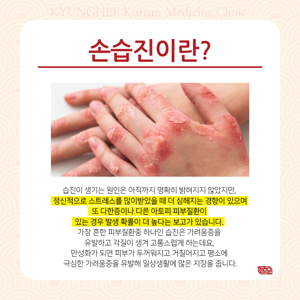 습진 가려움