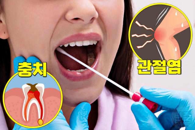 입이 마르는 이유, 쇼그렌증후군, 관절염, 팁줌