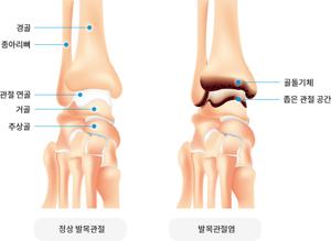 발목이 아플 때