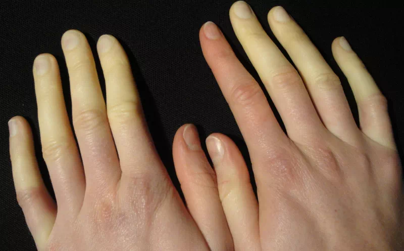 레이노이드 증후군