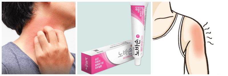 가려움증, 노바손크림, 화상 사진