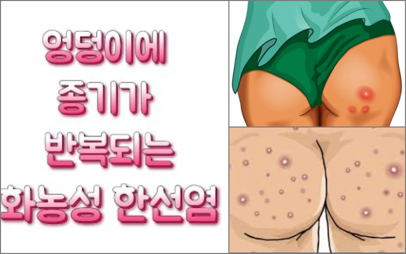 엉덩이에 뾰루지가 생긴 사람