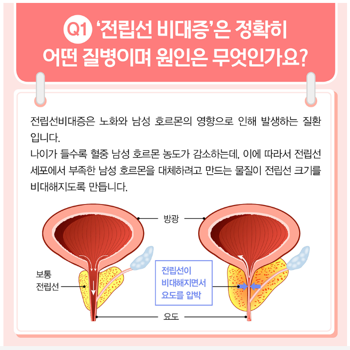 전립선 비대증