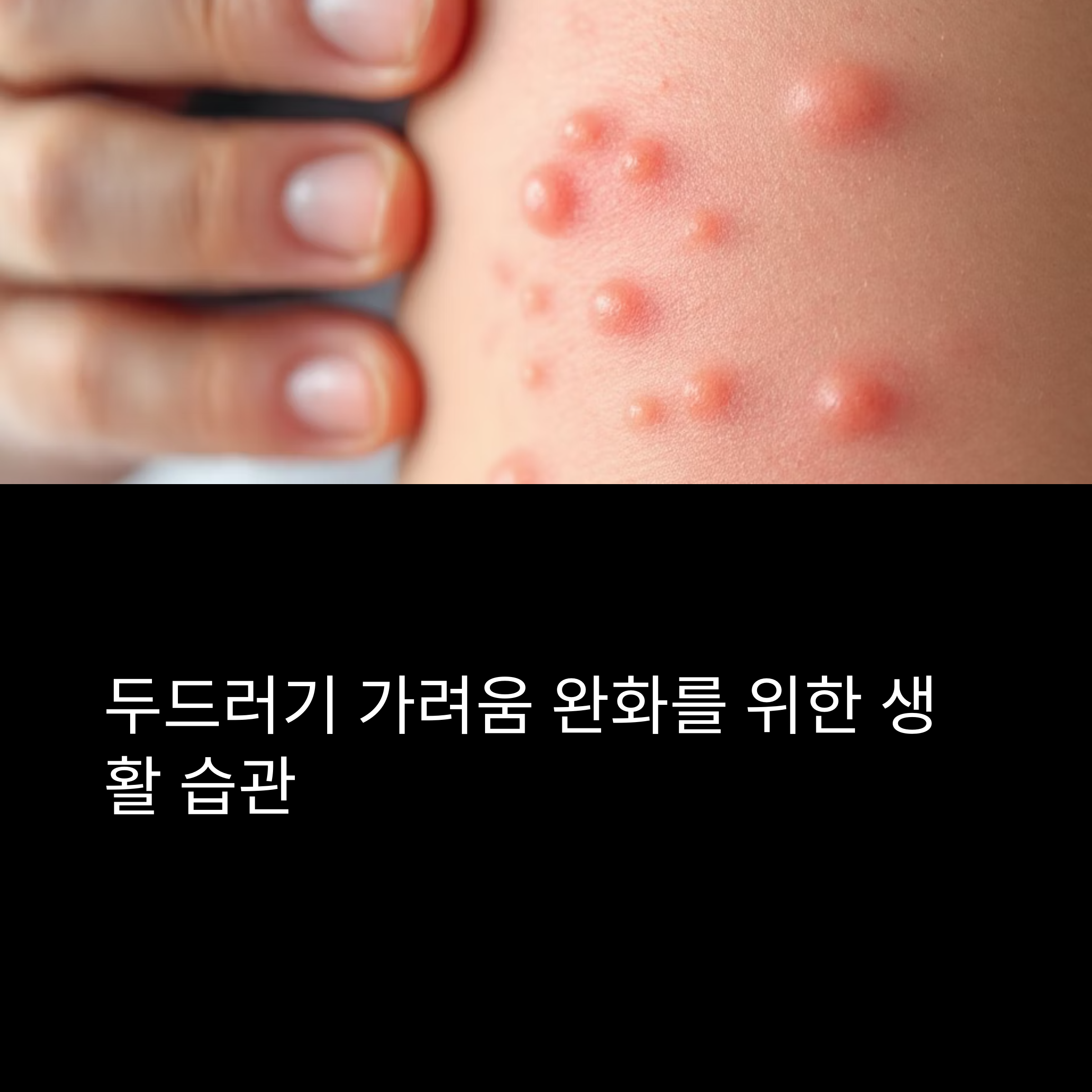 두드러기 가려움 완화 생활 습관