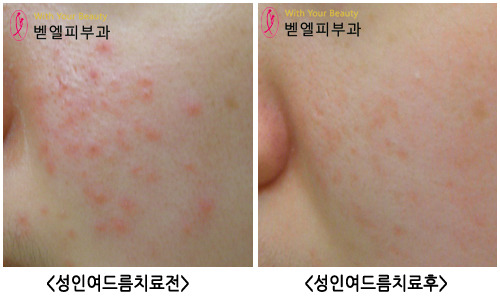 피부 트러블 치료 전과 후