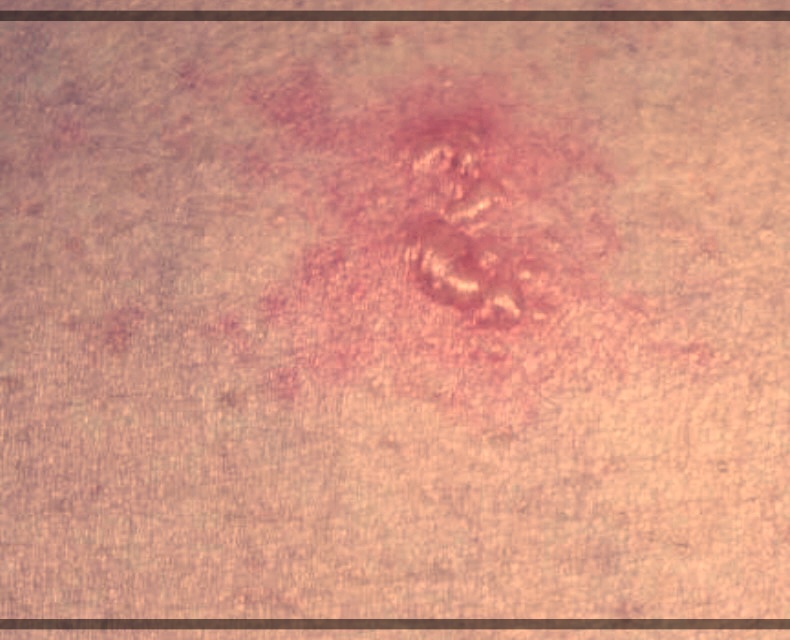 대상포진을 방치하면 생길 수 있는 심각한 결과?