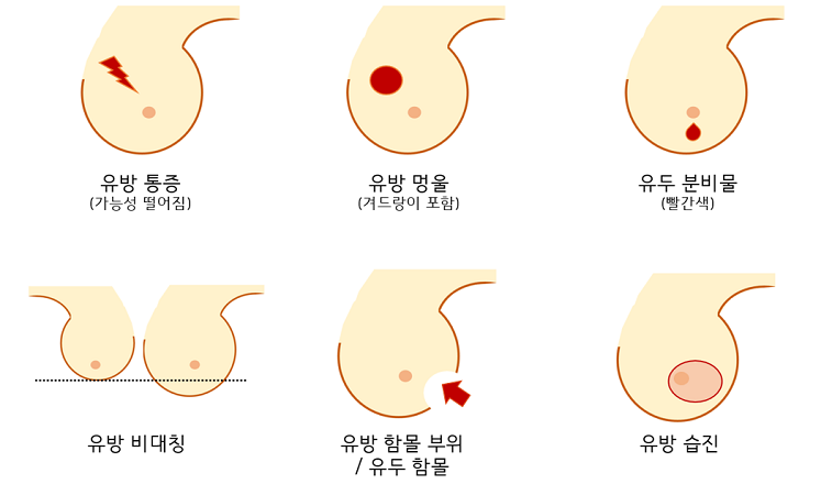 유방 통증, 멍울, 유두 분비물, 유방 비대칭, 유방 함몰/유두 함몰, 유방 습진 등 6가지 주요 유방암 증상을 보여주는 도표