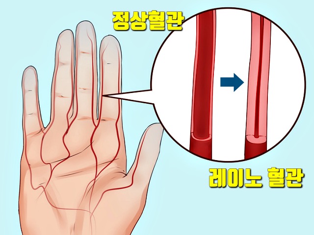 추울때 손가락 끝이 하얗게 레이노 증후군 증상 손가락 끝 말초혈관 발가락 끝이 찌릿찌릿