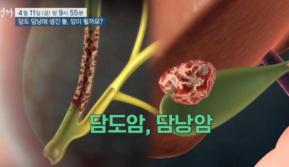 EBS명의-담도암명의-담낭암명의-방승민교수-황호경교수