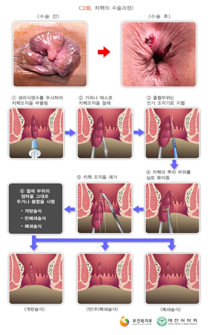치질 수술법/ 출처 - 보건복지부