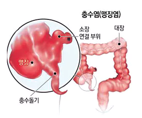충수염-위치