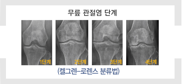 관절 콘드로이친 1200