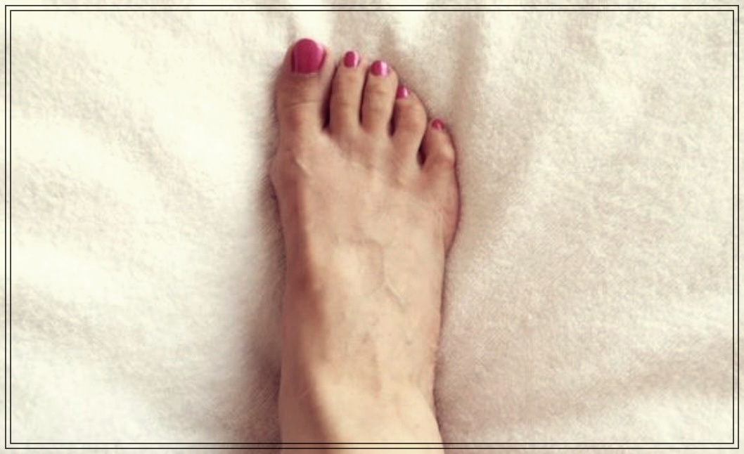 발바닥 고통, 그 원인은? 지간신경종의 정체와 치료법.