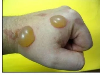 수족구병 증상과 예방 조치 방법 모음_15