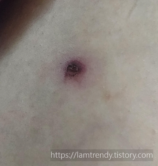 쥐젖 냉동치료 후 관리 부족으로 딱지