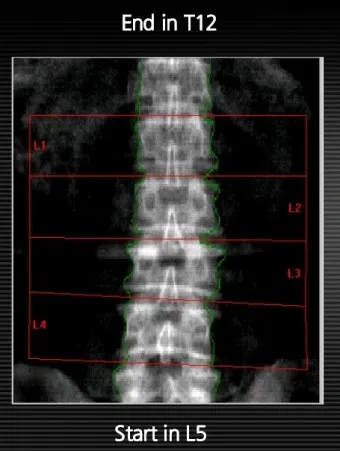 골밀도 검사 수치 골밀도 높이는 방법 간단 정리_20