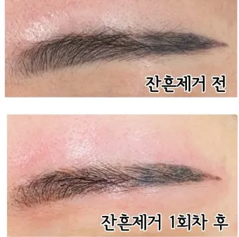 눈썹 문신 제거 방법 꿀팁_20
