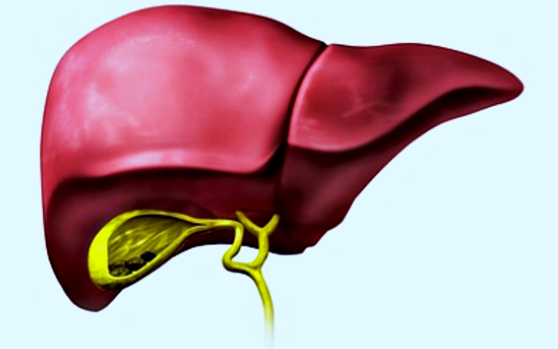 담낭염 원인과 발생 조건, 주요 증상, 치료 및 예방 방법