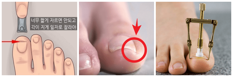 내성발톱, 내성발톱 교정기 사진