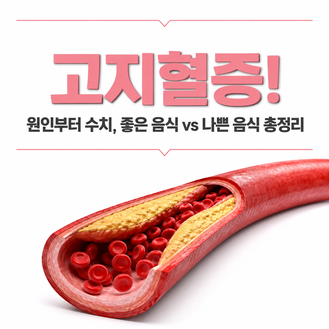고지혈증 이미지