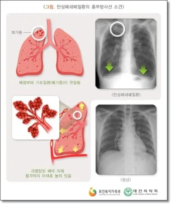 폐질환의 종류 7가지와 예방법 건강관리 필수_3