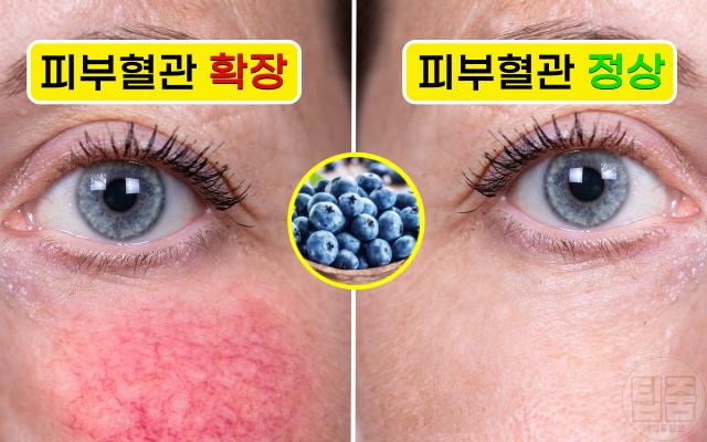 코 옆 볼 빨개짐 주사비 좋은 음식 블루베리