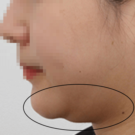 얼굴 지방흡입 전 여성의 모습