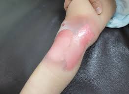 화상 물집 치료방법