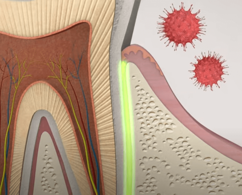 임플란트 주위염 ; 증상&amp;#44; 원인&amp;#44; 예방 및 관리방법 알아보기(재수술&amp;#44; 부작용&amp;#44; 재식립)