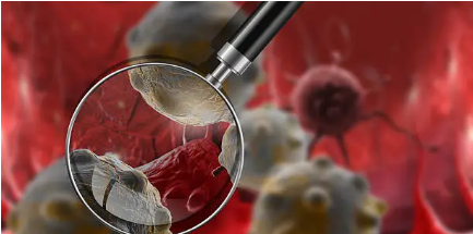 겸상 적혈구 질환