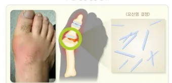 발가락 통풍 증상 및 대처방법_25