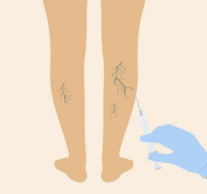 하지정맥류 증상 수술비용 좋은운동 등 총정리(2024 최신)