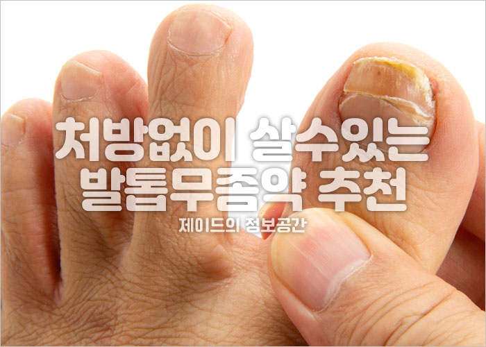 발톱무좀을 앓고 있는 사람의 발 이미지