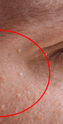 눈밑에 하얀 좁쌀