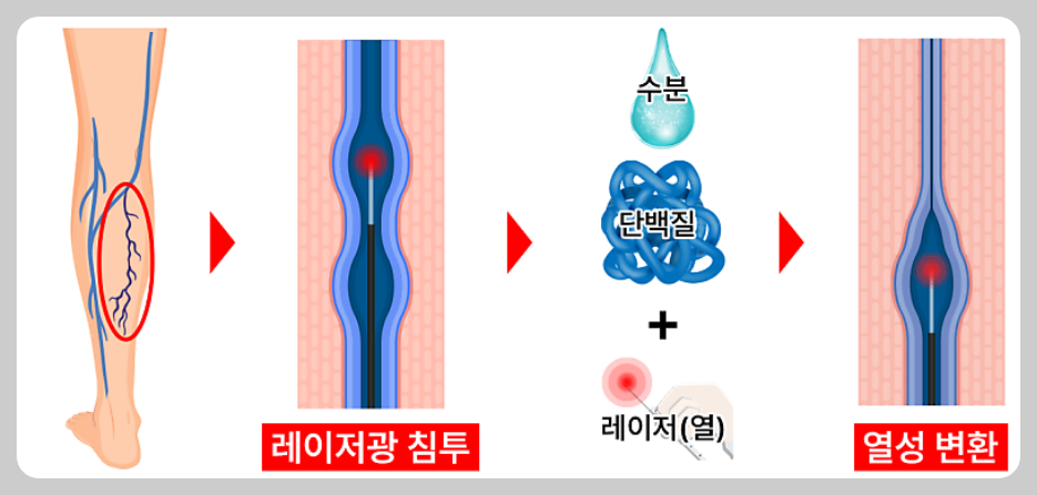 하지정맥류4