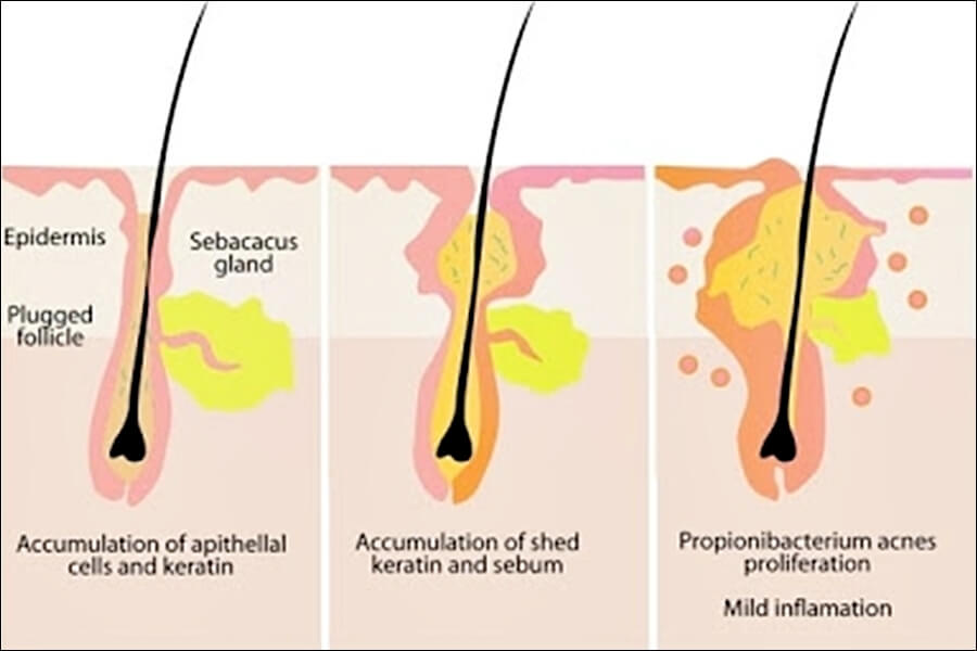 가드름 등드름 없애는 법 및 원인 총정리